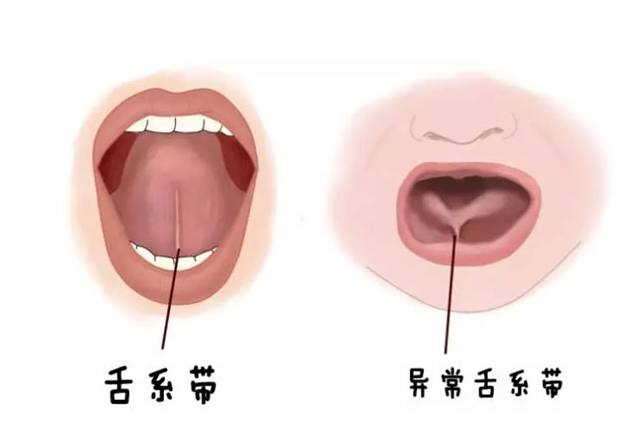 舌系帶過短